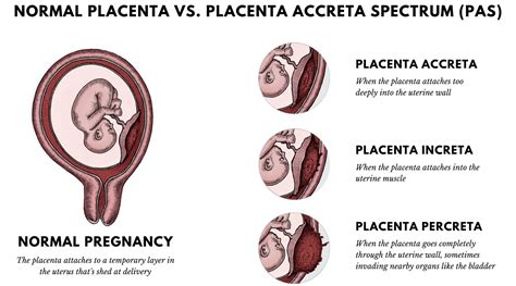 placenta acreta-1